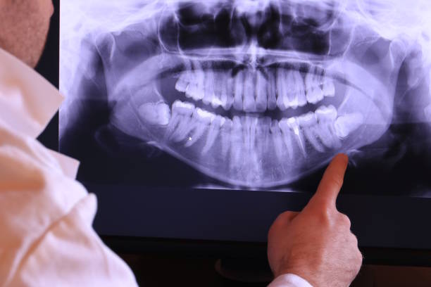 Best Emergency Wisdom Teeth Removal in Stro Valley, CA